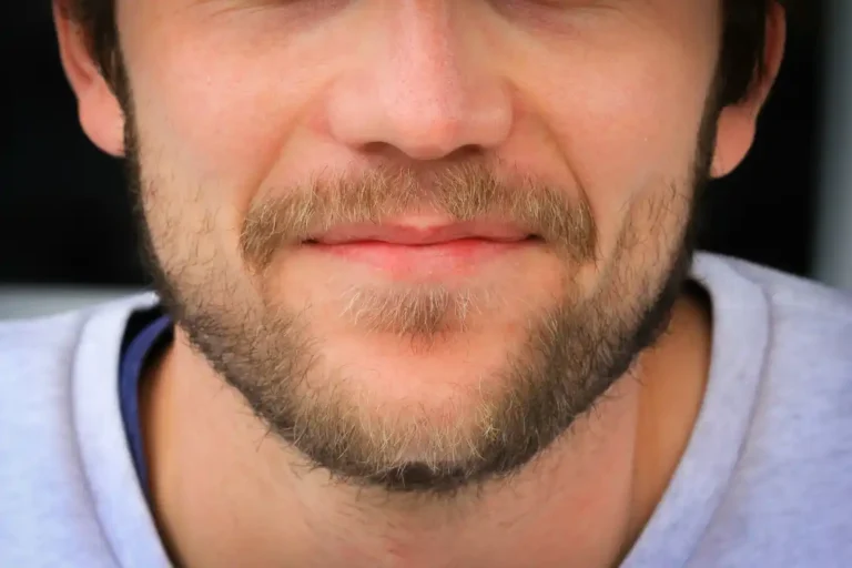 patchy beard